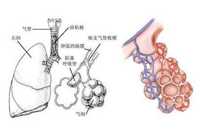 肺纤维化治疗—肺纤维化的致病因素分析