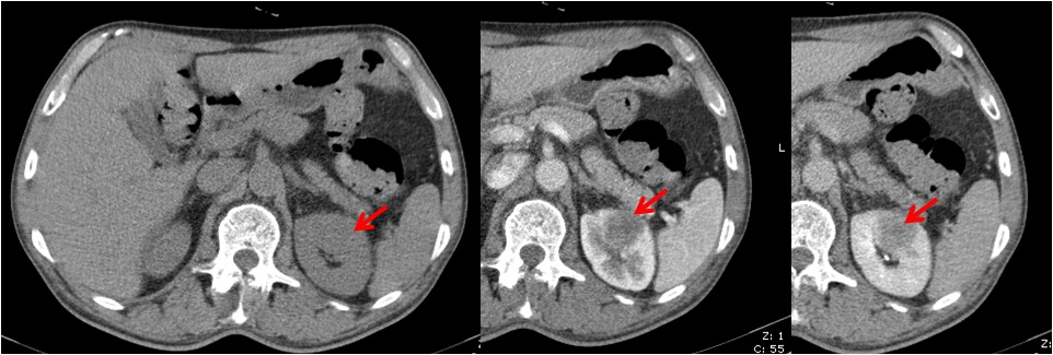 这个肾癌假如只做普通的不打药ct肯定会漏诊会酿成大祸