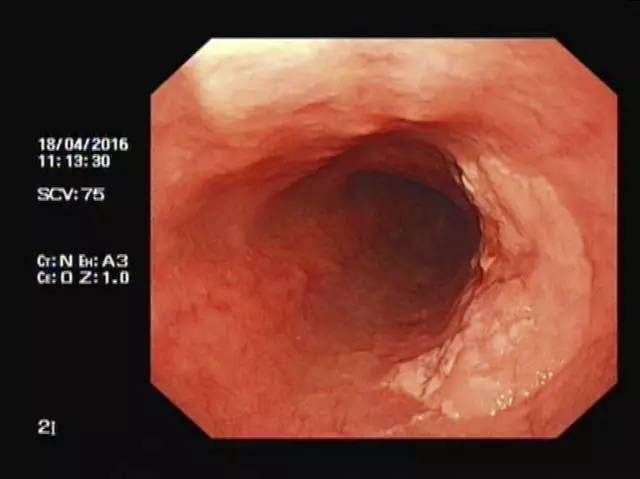 早期食管癌图片