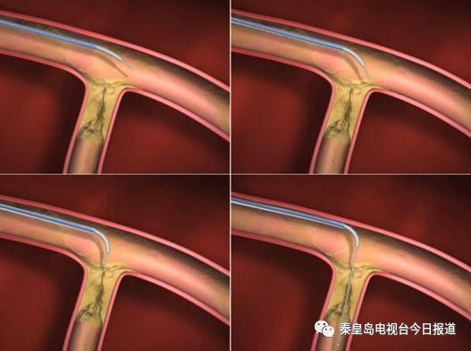 健康同行:介入治疗在出血和血管疾病中的应用