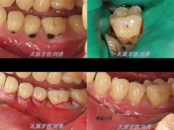 根向复位瓣手术增加附着龈宽度