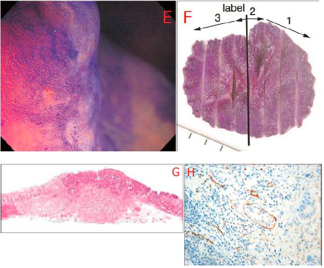 最终病理诊断为 adenocarcinoma(tub1>tub2)with adenoma,sm 2000μm