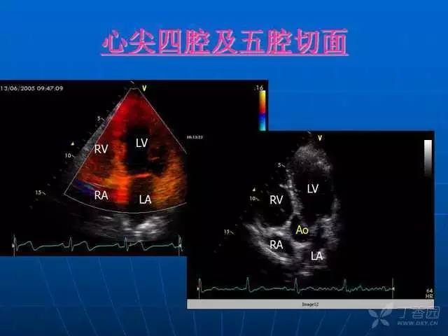 心内科基本功:超声心动图标准切面及正常值