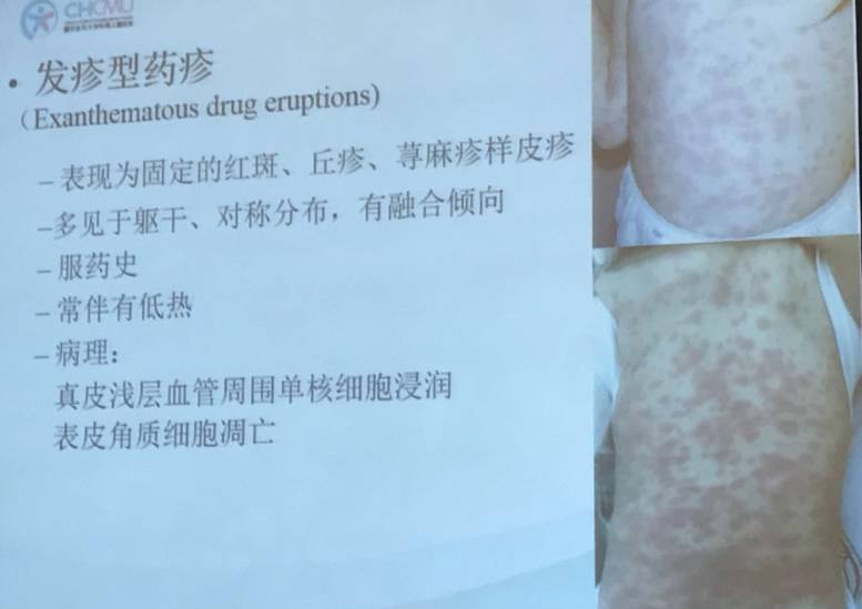 儿童荨麻疹如何诊断与鉴别看这一篇就够了