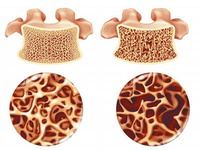 骨质疏松日:警惕"硬骨头"变成"脆桃酥"