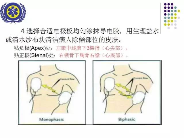 除颤仪的使用