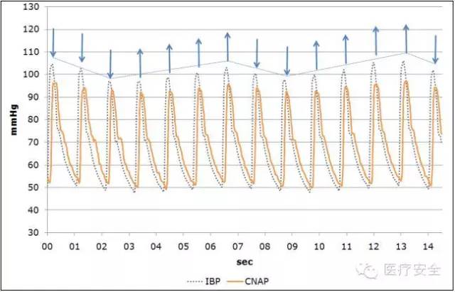 外文文献欣赏无创连续血压监测cnap与有创动脉血压监测ibp比较cnap