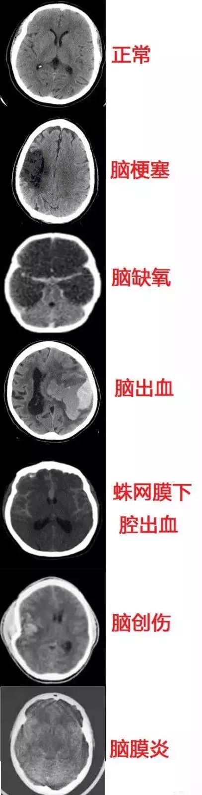 几种常见致死性脑病的ct表现形象记忆交感神经与副交感神经系统12对颅