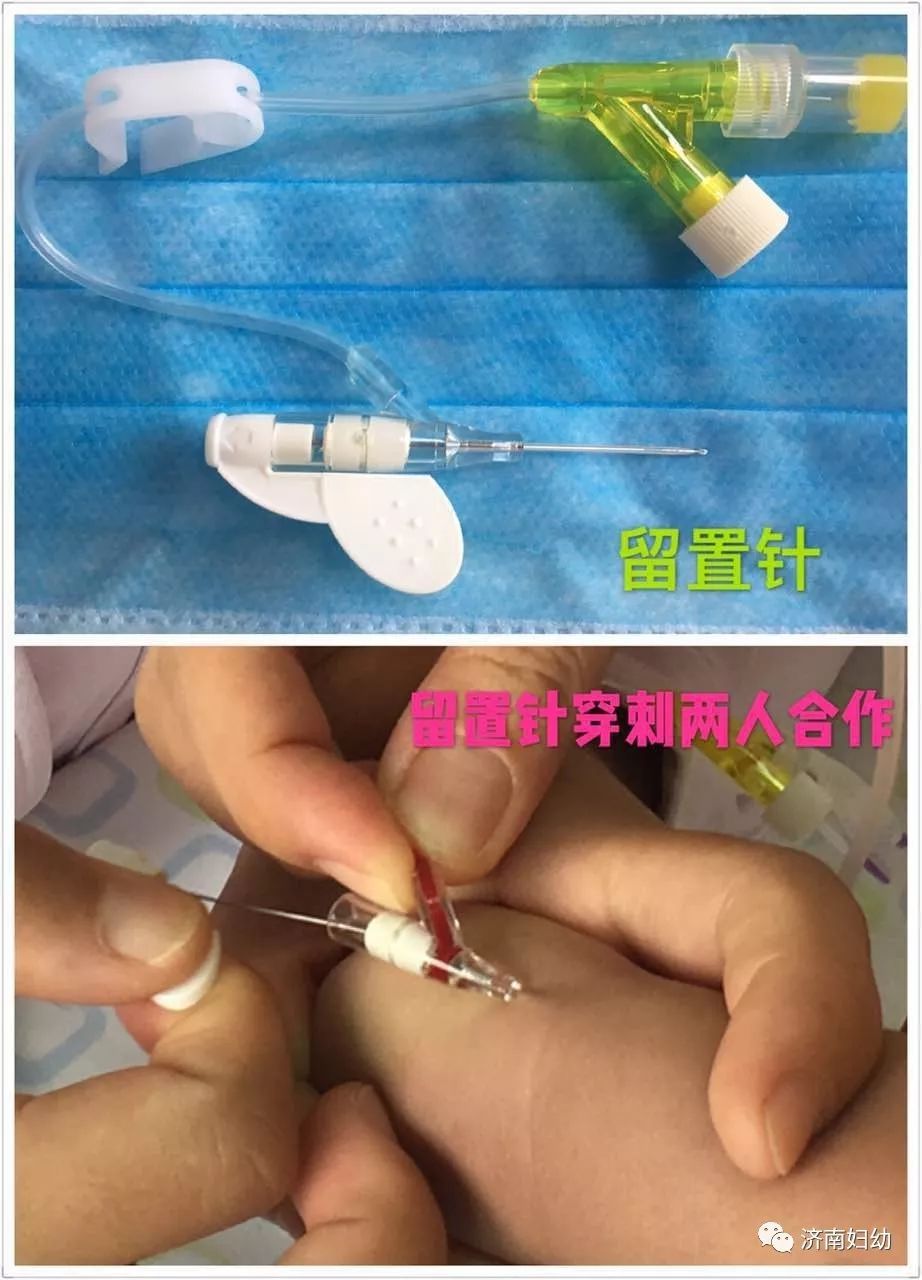 孩子输液还在纠结用钢针还是留置针吗