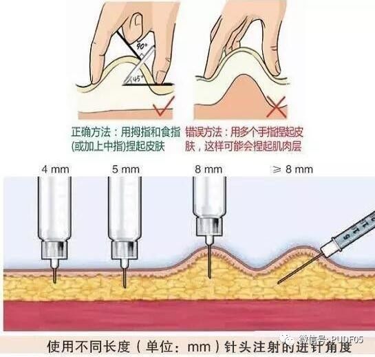 提示: 胰岛素注射笔针头的选择:针头长度的选择取决于注射部位皮下