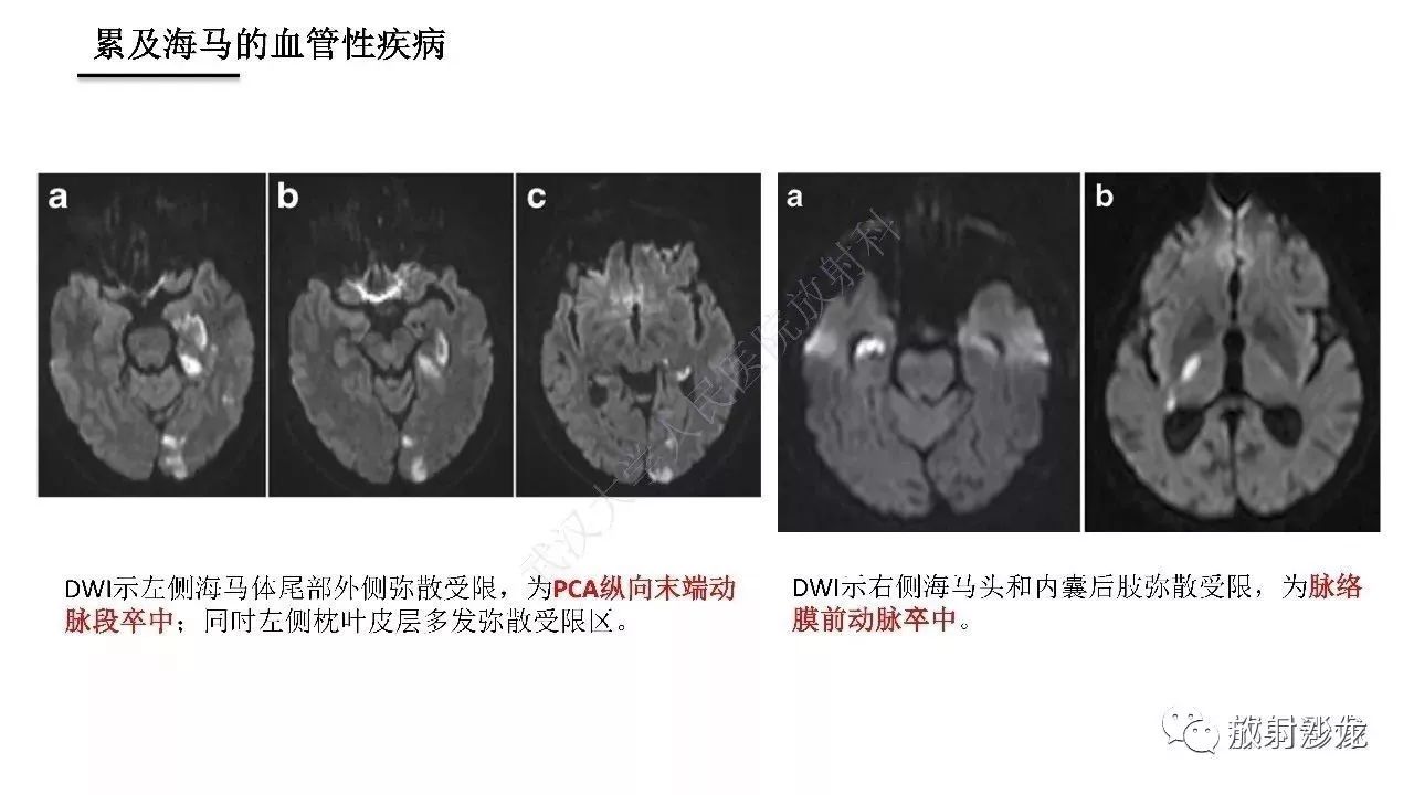 海马正常解剖与疾病影像诊断