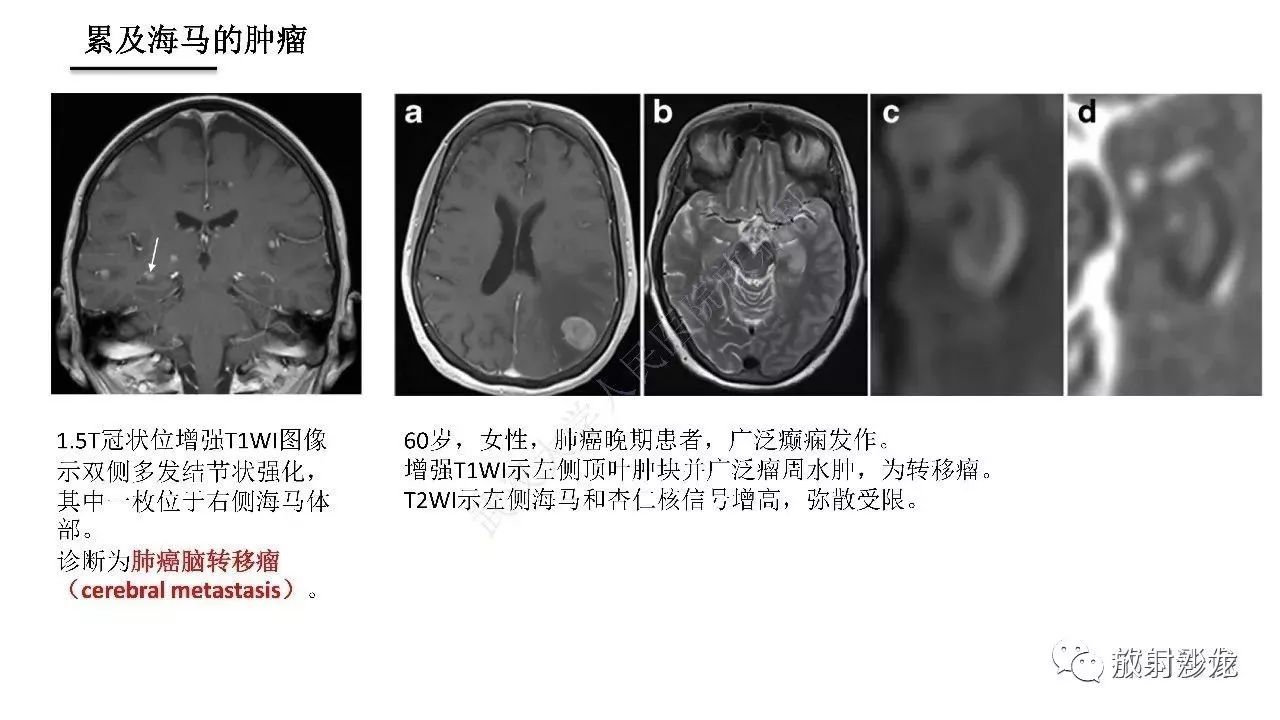 海马正常解剖与疾病影像诊断