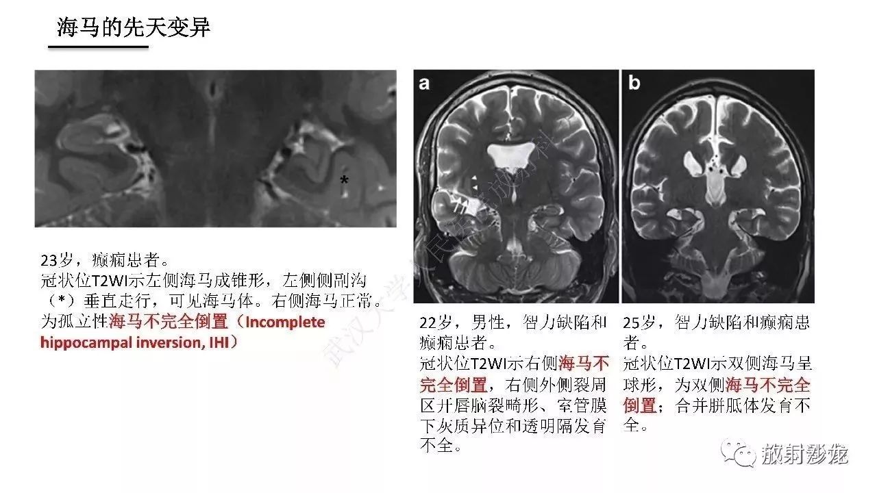 海马正常解剖与疾病影像诊断