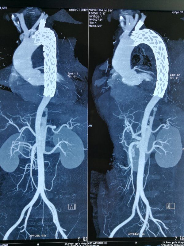 病例分享castor03分支型主动脉覆膜支架系统上市后病例分享江西省