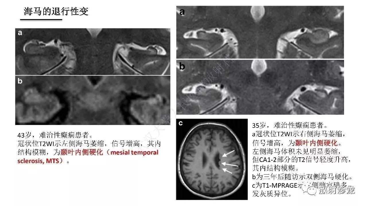 海马正常解剖与疾病影像诊断