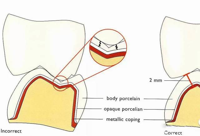 【牙科学堂】制备牙冠常被忽视的问题
