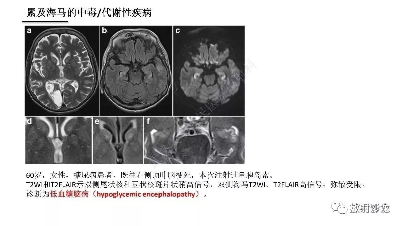 海马正常解剖与疾病影像诊断