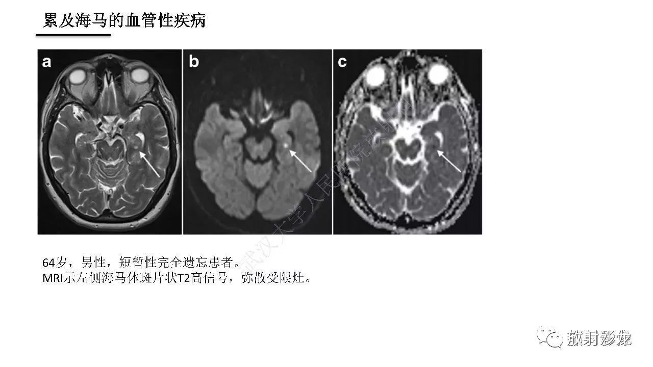 海马正常解剖与疾病影像诊断