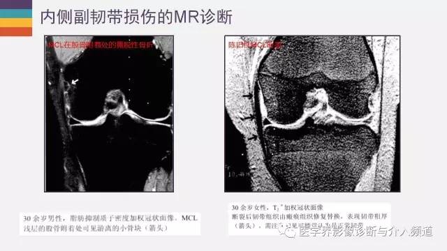 膝关节内侧副韧带受伤mr来确诊