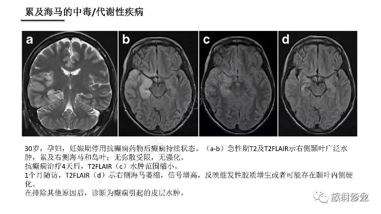 海马正常解剖与疾病影像诊断