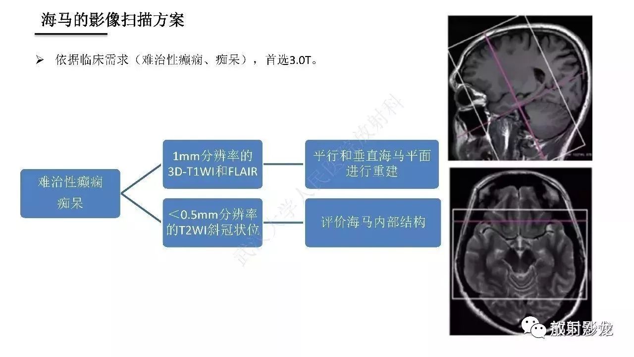 海马正常解剖与疾病影像诊断