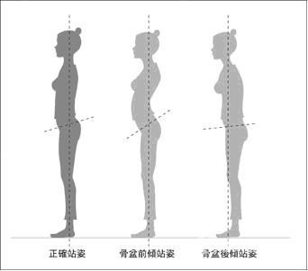 骨盆前倾