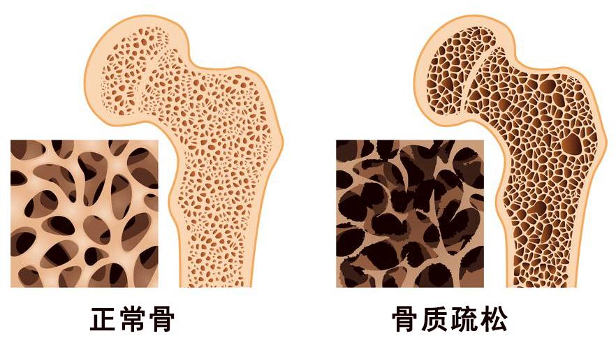 世界骨质疏松日丨骨质疏松的防治指南!每个人都应该