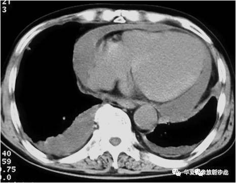【影像基础】ct也可大致定量心包积液