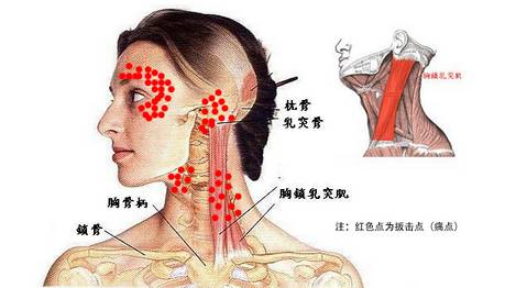 胸锁乳突肌损伤的诊断与治疗手法