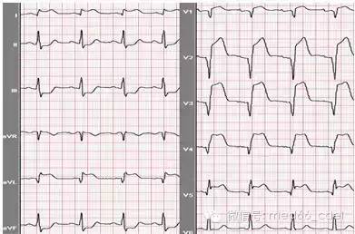 3mv,v1-v4呈典型异常q波.诊断:急性广泛前壁心肌梗死. 2.
