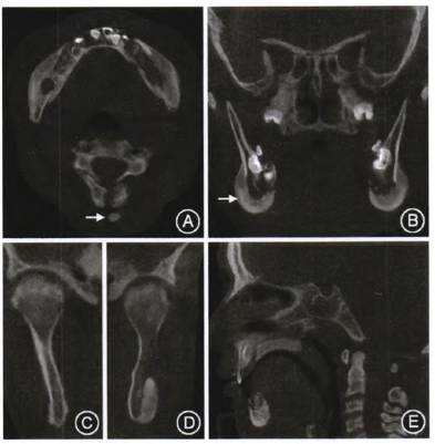 锥形束ct示下颌骨密度不均匀增高,双侧下颌体及下颌角颊舌侧均可见