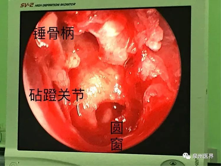 手术在耳内镜下进行,制作翻起鼓耳道皮瓣后发现锤骨柄向后内移位并与