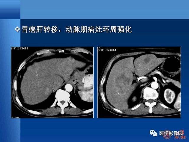 肝转移癌ct检查流程设计与优化探讨学习丨影像天地