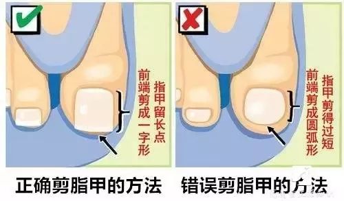 生活提醒脚趾甲老是长到肉里怎么办这个实用办法帮你搞定