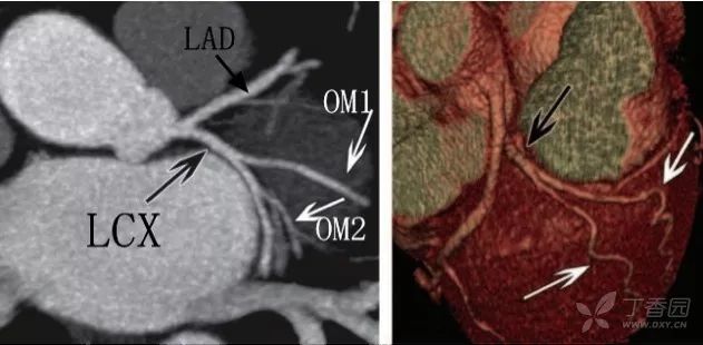 对角支 d 供应左心室图 4 人群约 15 可见 lad 和 lcx 中间的中间支