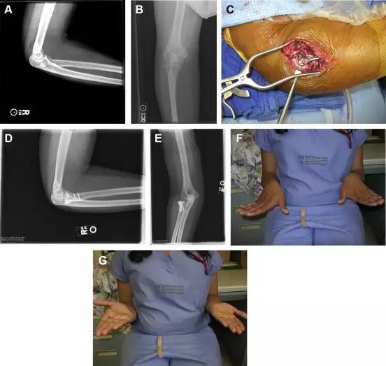 一篇搞定:成人肘关节骨折脱位的治疗