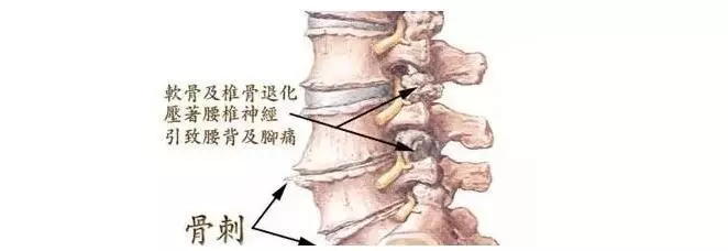 不可盲目消"骨刺",为你解读骨质增生