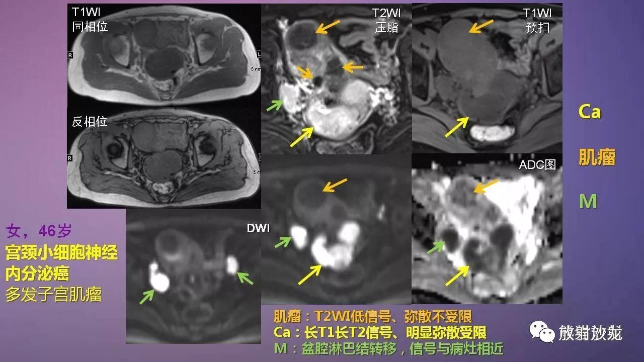 【专题】女性盆腔肿瘤的mri诊断