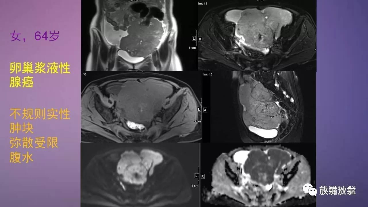 【专题】女性盆腔肿瘤的mri诊断