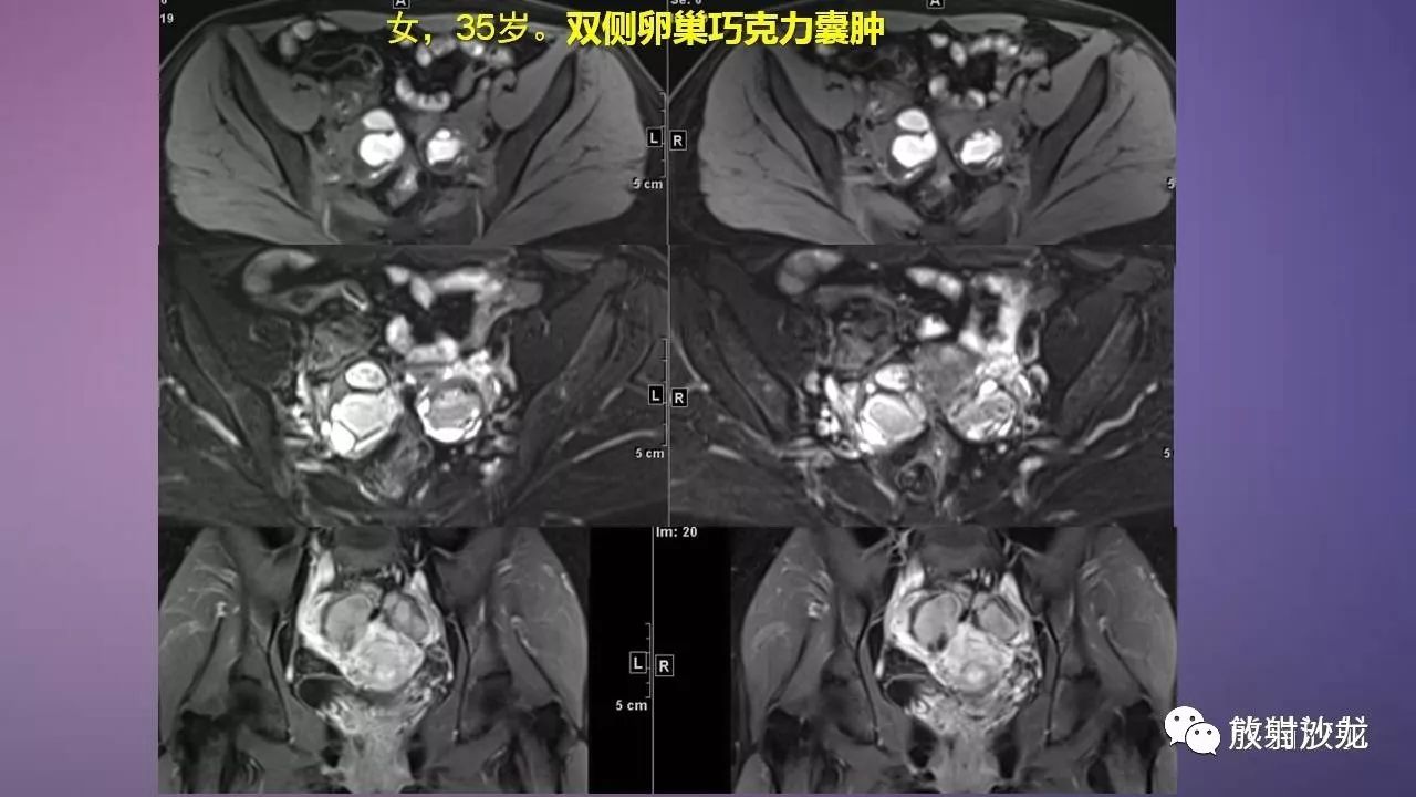 【专题】女性盆腔肿瘤的mri诊断