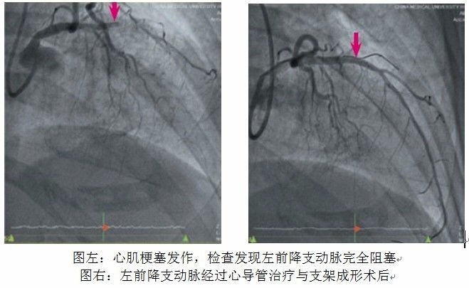 易使心肌梗塞死亡率升高的因素