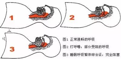 打鼾的原理是什么_打鼾是什么原因导致的