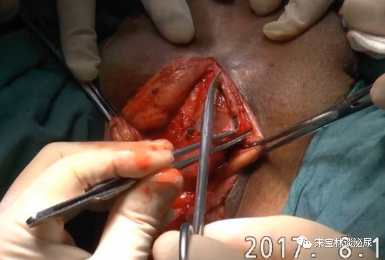 尿道狭窄段切除 端端吻合术(手术演示)