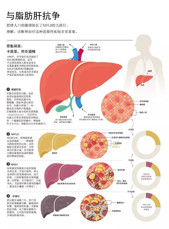 "低调"的健康杀手——脂肪肝