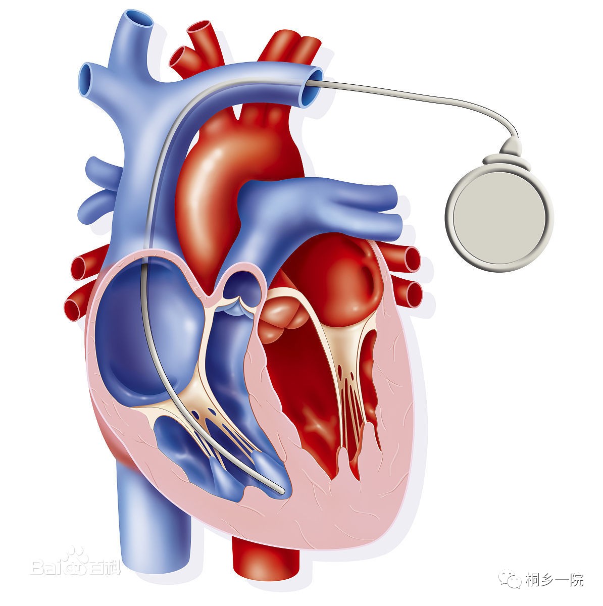 心脏瓣膜手册｜主动脉瓣狭窄：症状和病因 - 知乎