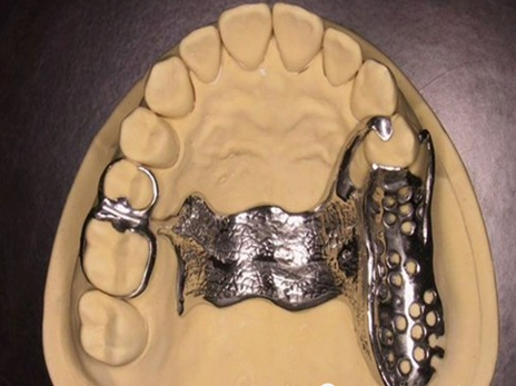 口腔可摘局部义齿支架设计大全(建议收藏)