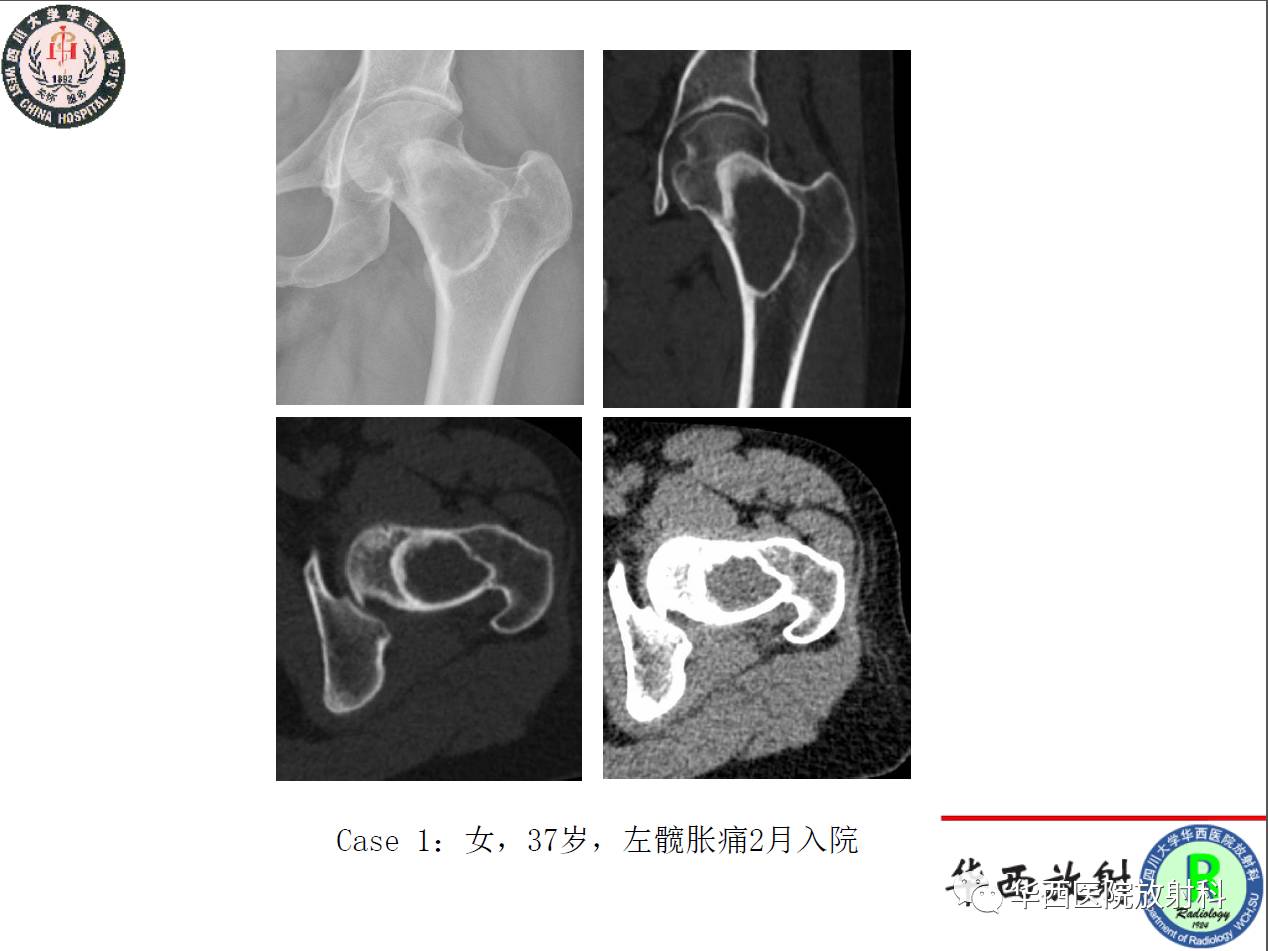 华西放射科深度业务学习系列之三十二—股骨颈局灶病变影像表现