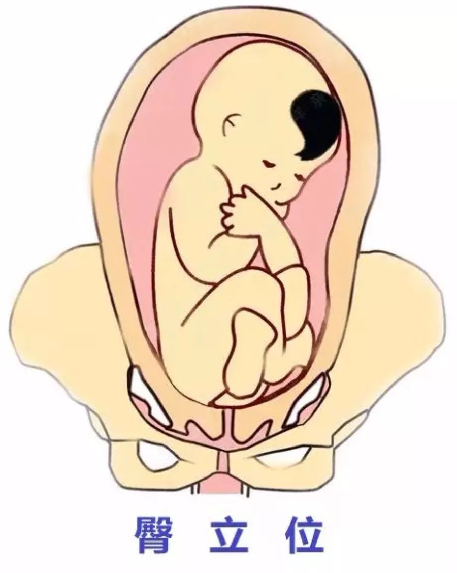 通常,医学上称枕前位为正常胎位,胎儿背朝前胸向后,两手交叉于胸前
