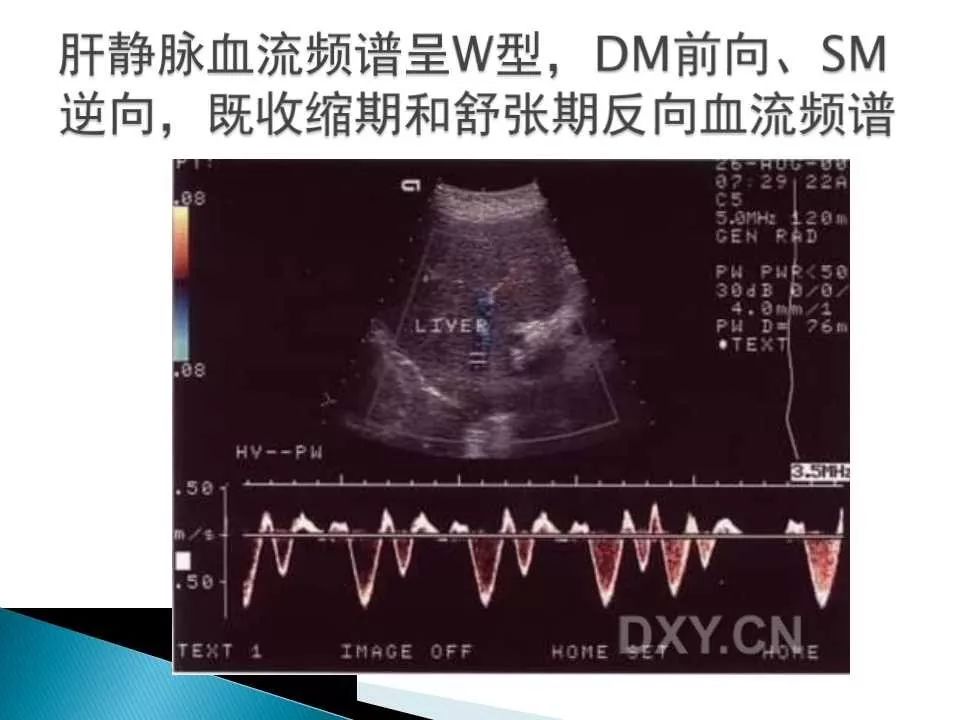 限制性心肌病超声诊断