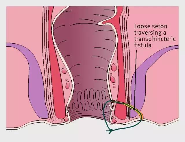 肛瘘是肛管或直肠下端与肛门旁皮肤之间发生的异常通道.